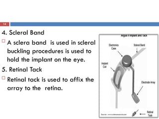 14
4. Scleral Band

A sclera band is used in scleral
buckling procedures is used to
hold the implant on the eye.
5. Retinal Tack

Retinal tack is used to affix the
array to the retina.
Source : www.sciencesource.com
 