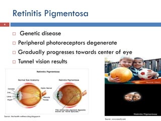 Retinitis Pigmentosa
4
Source : the-health-wellness-blog.blogspot.in
 Genetic disease
 Peripheral photoreceptors degenerate
 Gradually progresses towards center of eye
 Tunnel vision results
Source : www.nacuity.com
 
