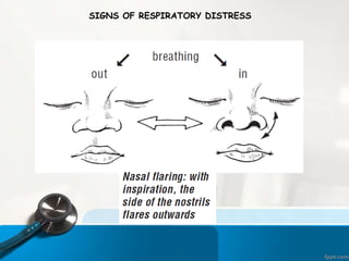 SIGNS OF RESPIRATORY DISTRESS
 