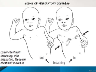 SIGNS OF RESPIRATORY DISTRESS
 