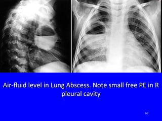 60
Air-fluid level in Lung Abscess. Note small free PE in RAir-fluid level in Lung Abscess. Note small free PE in R
pleural cavitypleural cavity
 