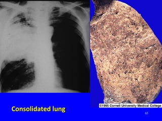 65
Consolidated lungConsolidated lung
 