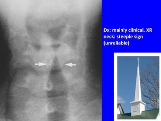 Dx: mainly clinical. XRDx: mainly clinical. XR
neck: steeple signneck: steeple sign
(unreliable)(unreliable)
 