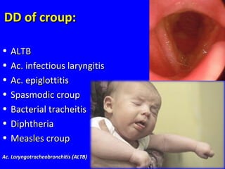 DD of croup:DD of croup:
• ALTBALTB
• Ac. infectious laryngitisAc. infectious laryngitis
• Ac. epiglottitisAc. epiglottitis
• Spasmodic croupSpasmodic croup
• Bacterial tracheitisBacterial tracheitis
• DiphtheriaDiphtheria
• Measles croupMeasles croup
Ac. Laryngotracheobronchitis (ALTB)Ac. Laryngotracheobronchitis (ALTB)
 