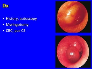 DxDx
• History, autoscopyHistory, autoscopy
• MyringotomyMyringotomy
• CBC, pus CSCBC, pus CS
93
 