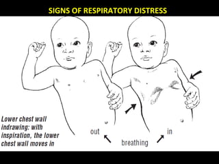 SIGNS OF RESPIRATORY DISTRESSSIGNS OF RESPIRATORY DISTRESS
 