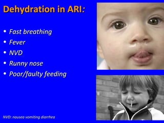 45
Dehydration in ARIDehydration in ARI::
• Fast breathingFast breathing
• FeverFever
• NVDNVD
• Runny noseRunny nose
• Poor/faulty feedingPoor/faulty feeding
NVD: nausea vomiting diarrheaNVD: nausea vomiting diarrhea
 