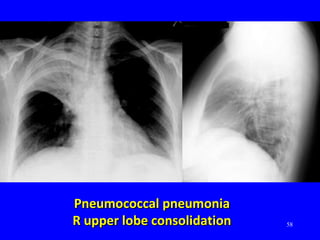 58
Pneumococcal pneumoniaPneumococcal pneumonia
R upper lobe consolidationR upper lobe consolidation
 