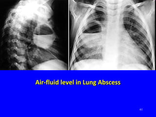 61
Air-fluid level in Lung AbscessAir-fluid level in Lung Abscess
 