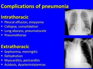 Complications of pneumoniaComplications of pneumonia
IntrathoracicIntrathoracic
• Pleural effusion, empyemaPleural effusion, empyema
• Collapse, consolidationCollapse, consolidation
• Lung abscess, pneumatoceleLung abscess, pneumatocele
• PneumothoraxPneumothorax
ExtrathoracicExtrathoracic
• Septicemia, meningitisSepticemia, meningitis
• DehydrationDehydration
• Myocarditis, pericarditisMyocarditis, pericarditis
• Acidosis, dyselectrolytemiasAcidosis, dyselectrolytemias
 