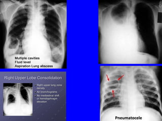64
PneumatocelePneumatocele
 