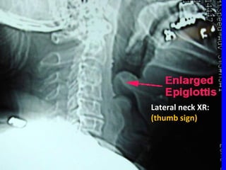 Lateral neck XR:Lateral neck XR:
(thumb sign)(thumb sign)
 