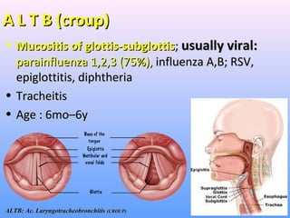 A L T B (croup)A L T B (croup)
• Mucositis of glottis-subglottisMucositis of glottis-subglottis;; usually viral:usually viral:
parainfluenza 1,2,3 (75%),parainfluenza 1,2,3 (75%), influenza A,B; RSV,influenza A,B; RSV,
epiglottitis, diphtheriaepiglottitis, diphtheria
• TracheitisTracheitis
• Age : 6mo–6yAge : 6mo–6y
ALTB: Ac. LaryngotracheobronchitisALTB: Ac. Laryngotracheobronchitis (CROUP)(CROUP)
 