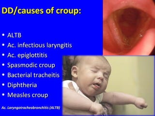 DD/causes of croup:DD/causes of croup:
• ALTBALTB
• Ac. infectious laryngitisAc. infectious laryngitis
• Ac. epiglottitisAc. epiglottitis
• Spasmodic croupSpasmodic croup
• Bacterial tracheitisBacterial tracheitis
• DiphtheriaDiphtheria
• Measles croupMeasles croup
Ac. Laryngotracheobronchitis (ALTB)Ac. Laryngotracheobronchitis (ALTB)
 