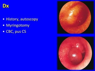 DxDx
• History, autoscopyHistory, autoscopy
• MyringotomyMyringotomy
• CBC, pus CSCBC, pus CS
94
 