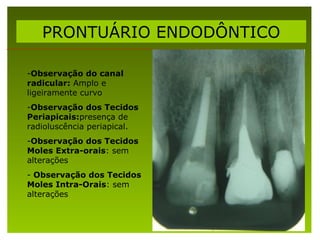 PRONTUÁRIO ENDODÔNTICO

-Observação do canal
radicular: Amplo e
ligeiramente curvo
-Observação dos Tecidos
Periapicais:pre...
