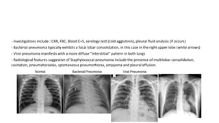 - Investigations include : CXR, FBC, Blood C+S, serology test (cold agglutinin), pleural fluid analysis (if occurs)
- Bacterial pneumonia typically exhibits a focal lobar consolidation, in this case in the right upper lobe (white arrows)
- Viral pneumonia manifests with a more diffuse “interstitial” pattern in both lungs
- Radiological features suggestive of Staphylococcal pneumonia include the presence of multilobar consolidation,
cavitation, pneumatocoeles, spontaneous pneumothorax, empyema and pleural effusion.
 