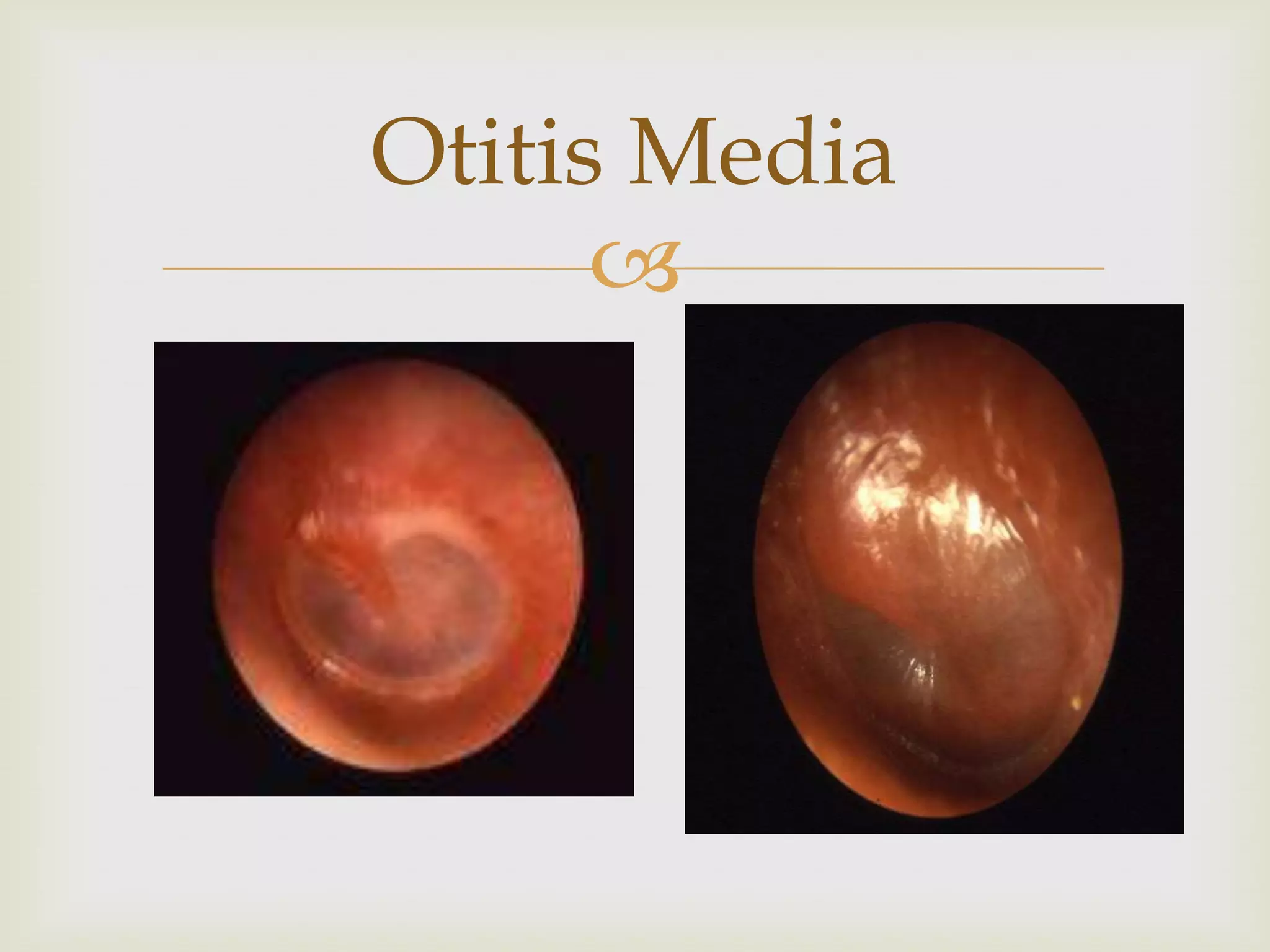 
Otitis Media
 