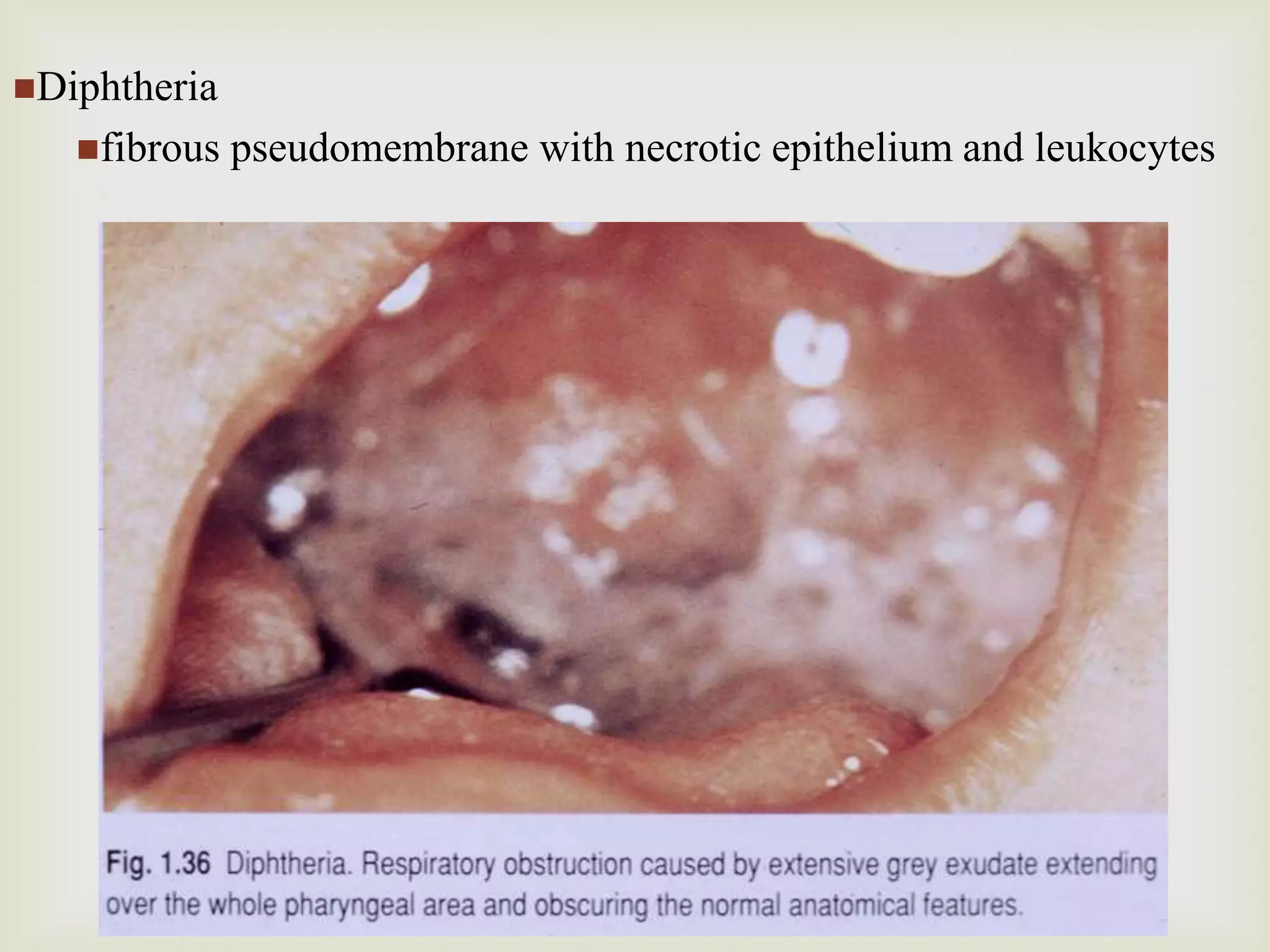 Diphtheria
fibrous pseudomembrane with necrotic epithelium and leukocytes
 