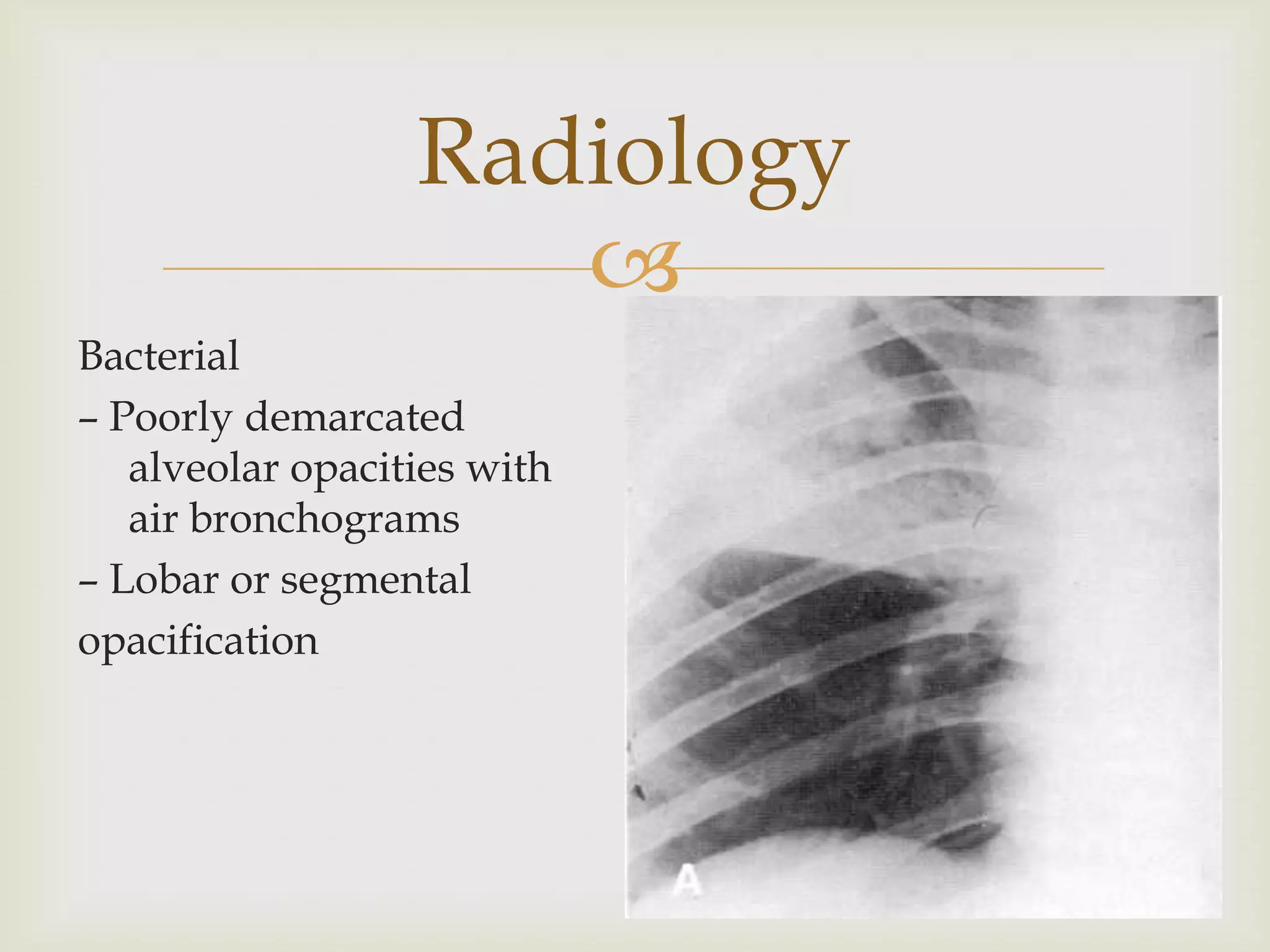 
Bacterial
– Poorly demarcated
alveolar opacities with
air bronchograms
– Lobar or segmental
opacification
Radiology
 
