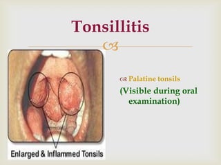 
Tonsillitis
 Palatine tonsils
(Visible during oral
examination)
 