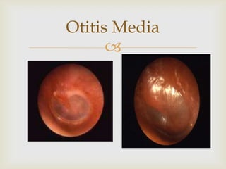 
Otitis Media
 