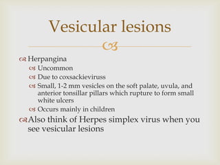 
 Herpangina
 Uncommon
 Due to coxsackieviruss
 Small, 1-2 mm vesicles on the soft palate, uvula, and
anterior tonsillar pillars which rupture to form small
white ulcers
 Occurs mainly in children
Also think of Herpes simplex virus when you
see vesicular lesions
Vesicular lesions
 