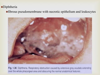 Diphtheria
fibrous pseudomembrane with necrotic epithelium and leukocytes
 