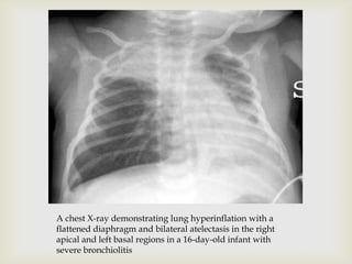 A chest X-ray demonstrating lung hyperinflation with a
flattened diaphragm and bilateral atelectasis in the right
apical and left basal regions in a 16-day-old infant with
severe bronchiolitis
 