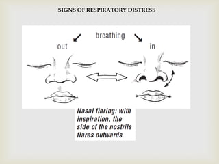 
SIGNS OF RESPIRATORY DISTRESS
 
