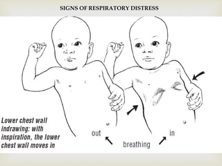 
SIGNS OF RESPIRATORY DISTRESS
 