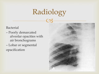 
Bacterial
– Poorly demarcated
alveolar opacities with
air bronchograms
– Lobar or segmental
opacification
Radiology
 