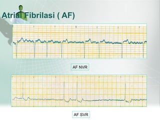 Gambaran EKG dengan Aritmia ggn pembentukan p3.ppt