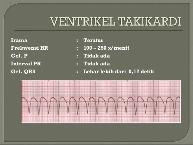 Irama Vt / ELEKTROKARDIOGRAFI (EKG) - idarosidawati / See more of irama