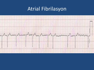 Atrial Fibrilasyon
 