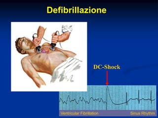 Defibrillazione
DC-Shock
Sinus RhythmVentricular Fibrillation
 