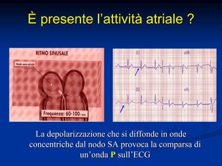 È presente l’attività atriale ?
La depolarizzazione che si diffonde in onde
concentriche dal nodo SA provoca la comparsa di
un’onda P sull’ECG
 