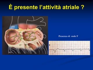 È presente l’attività atriale ?
Presenza di onde F
 