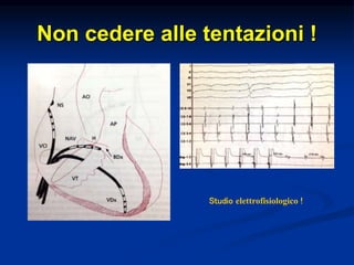 Non cedere alle tentazioni !
Studio elettrofisiologico !
 