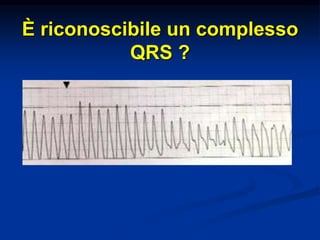 È riconoscibile un complesso
QRS ?
 