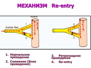 МЕХАНИЗМ Re-entry




1. Нормальное       3. Ретроградное
   проведение       проведение
2. Снижение (блок   4. Re-entry
   проведения)
 