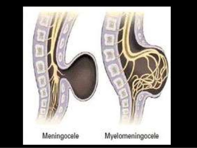 Ariunaa congenital spine disorders