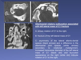 Atlantoaxial rotatory subluxation associated
with left lateral mass of C1 fracture
A: shows rotation of C1 to the right.
B: fracture of the left lateral mass of C1
C: asymmetry of the lateral atlanto-dental
spaces (black arrows) and a difference in the
atlantoaxial joint spaces (white arrows)
secondary to rotational malalignment.
Increased transverse diameter of the left lateral
mass of C1 (black dot) and truncated
appearance on the right (white dot) indicate
rotation of C1 to the right.
 