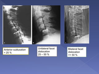 Anterior subluxation
< 25 %
Unilateral facet
dislocation
25 – 50 %
Bilateral facet
dislocation
>> 50 %
 