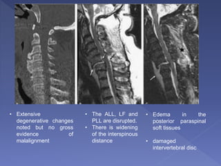 • Extensive
degenerative changes
noted but no gross
evidence of
malalignment
• The ALL, LF and
PLL are disrupted.
• There is widening
of the interspinous
distance
• Edema in the
posterior paraspinal
soft tissues
• damaged
intervertebral disc
 