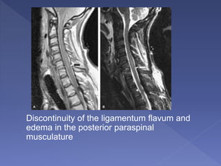 Discontinuity of the ligamentum flavum and
edema in the posterior paraspinal
musculature
 