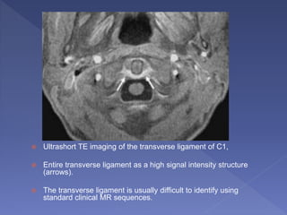  Ultrashort TE imaging of the transverse ligament of C1,
 Entire transverse ligament as a high signal intensity structure
(arrows).
 The transverse ligament is usually difficult to identify using
standard clinical MR sequences.
 