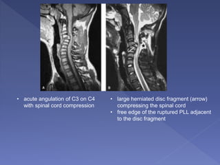 • acute angulation of C3 on C4
with spinal cord compression
• large herniated disc fragment (arrow)
compressing the spinal cord
• free edge of the ruptured PLL adjacent
to the disc fragment
 