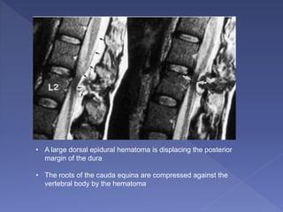 • A large dorsal epidural hematoma is displacing the posterior
margin of the dura
• The roots of the cauda equina are compressed against the
vertebral body by the hematoma
 
