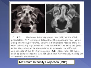 Maximum Intensity Projection (MIP)
 
